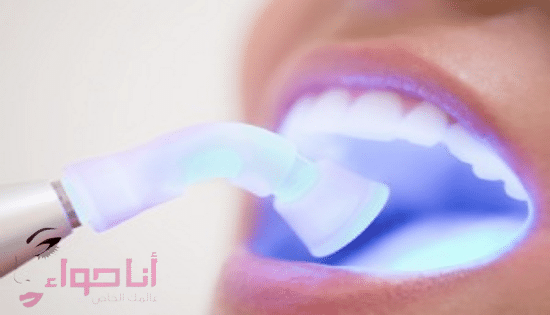 تبييض الاسنان بالليزر -2