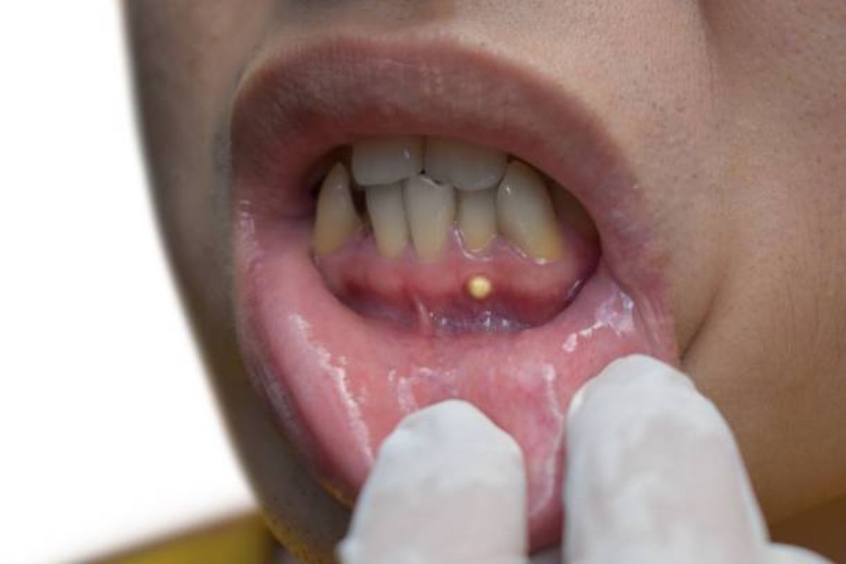 الفرق بين خراج اللثة وخراج الأسنان