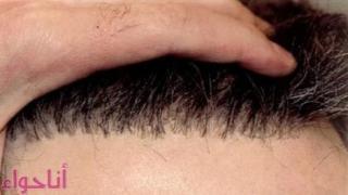 مراحل زراعة الشعر بالتفصيل مع شرح لزراعة الشعر بالفيديو