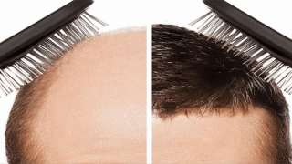 زراعة الشعر للرجال والنساء وطرق زراعة الشعر ومعلومات هامة